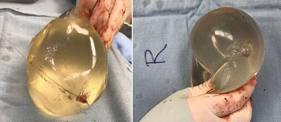 Both breast implants show that the bullet had shot through them.

